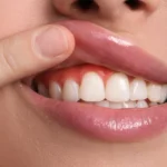 Diş Eti Kanaması Neden Olur