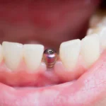What is a dental implant and how does it look