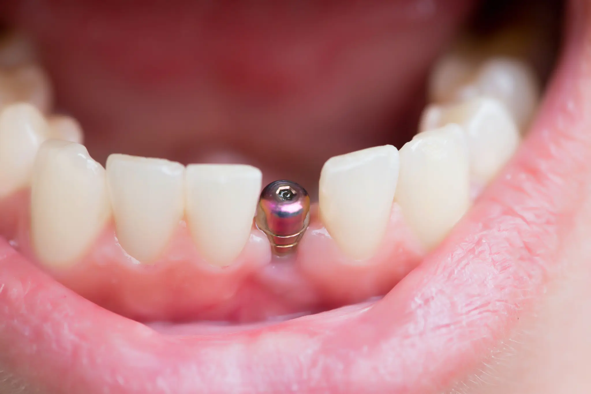 What is a dental implant and how does it look